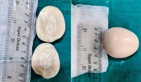 egg tumor অস্ত্রোপচারের পর পাওয়া সেই টিউমার।