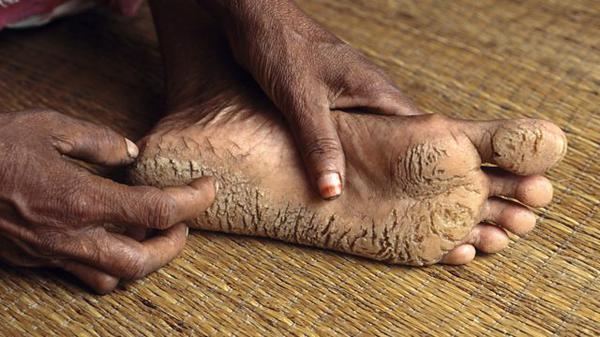 arsenic poisoning